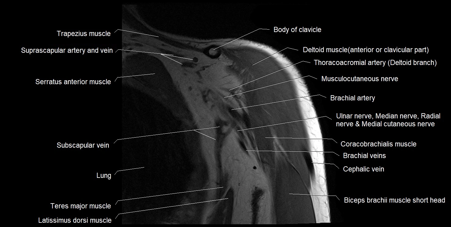 mri shoulder coronal cross sectional anatomy image 3.webp